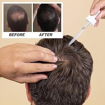 Amazon.com : Shapiro MD Hair Growth Experts Men's Regrowth Kit